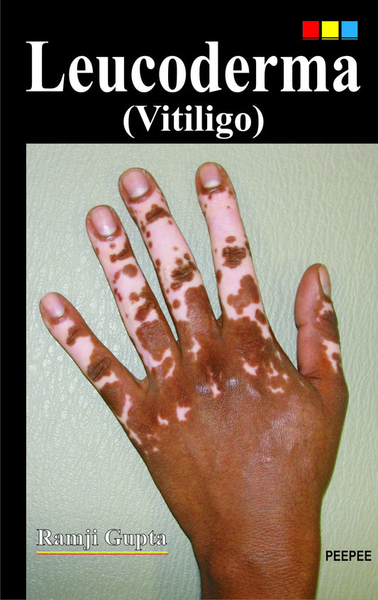 Leucoderma (Vitiligo)-Ramji Gupta