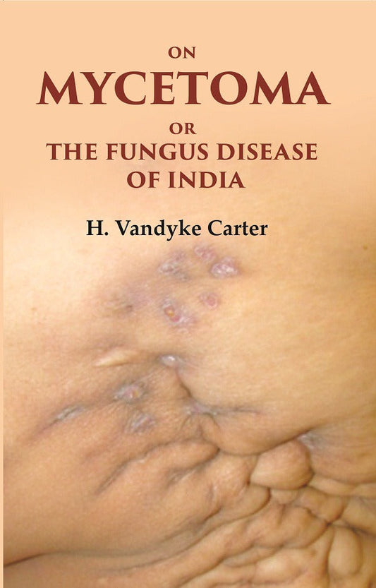 On Mycetoma or the Fungus Disease of India - Gyan Books