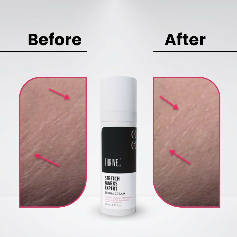 ThriveCo Stretch Marks Expert Serum Cream 