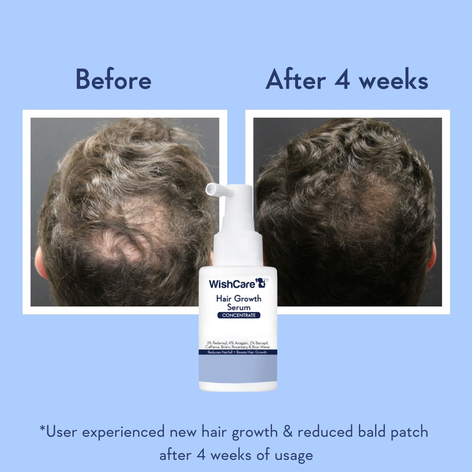 Wishcare Hair Growth Serum Concentrate In-Vivo Tested Redensyl, Anagain, Biotin,Keratin & Rice Water  Grab2Buy Wishcare Grab2Buy