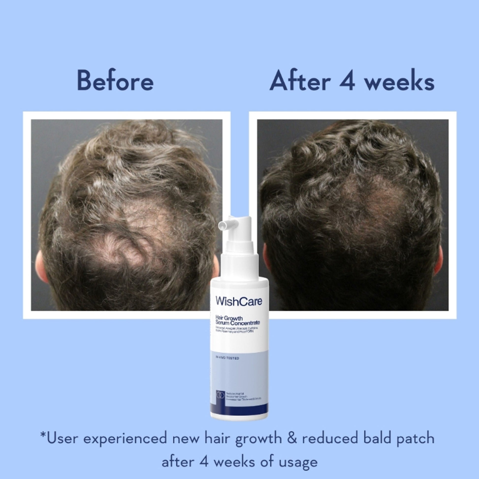 WishCare Hair Growth Serum Concentrate with Redensyl & Rosemary-In-Vivo Tested-Controls Hairfall  Grab2Buy Wishcare Grab2Buy