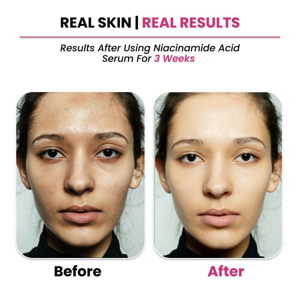 Thriveco 10% Niacinamide + 1% Zinc Pca Serum 