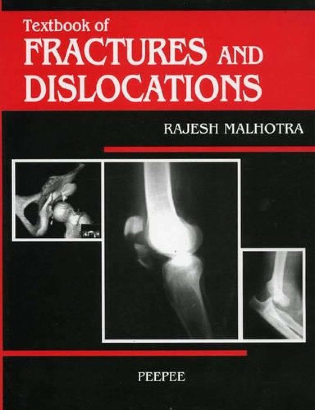 Textbook Of Fractures And Dislocations: Volume 1-Malhotra  Grab2Buy Peepee Publishers Grab2Buy