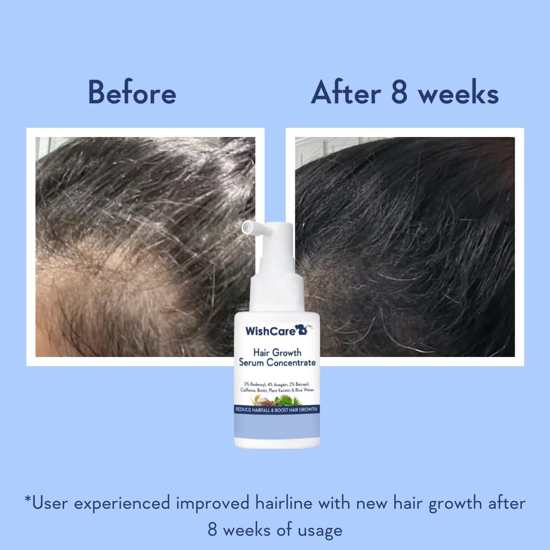 Wishcare Hair Growth Serum Concentrate With 3% Redensyl, 4% Anagain, Rice Water, Biotin  Grab2Buy Wishcare Grab2Buy