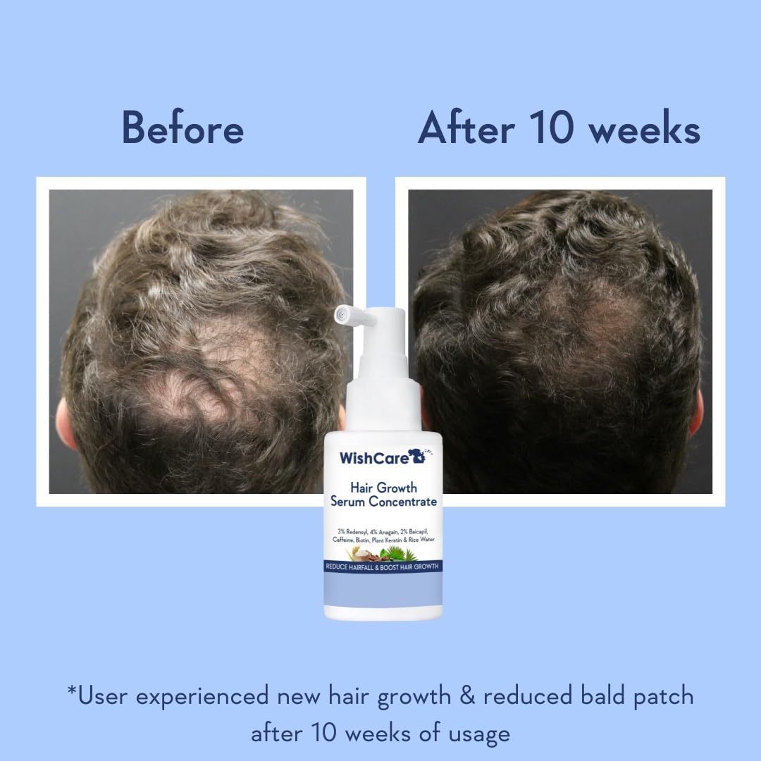 Wishcare Hair Growth Serum Concentrate With 3% Redensyl, 4% Anagain, Rice Water, Biotin  Grab2Buy Wishcare Grab2Buy