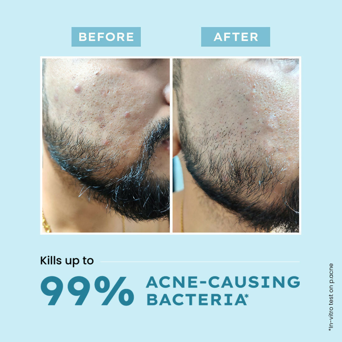 Hyphen By Kriti Sanon Acne Defence Daily Serum With 2% Salicylic Acid For Active Acne & Breakouts 