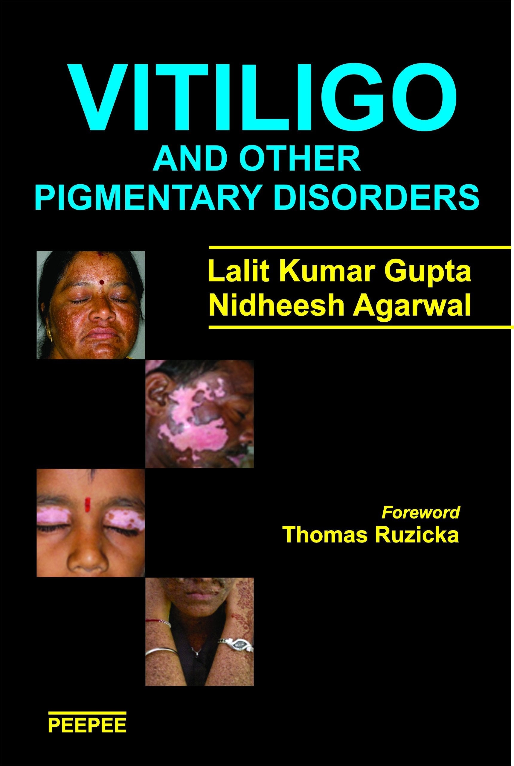 Vitiligo And Other Pigmentary Disorders-Lalit Gupta  Grab2Buy Peepee Publishers Grab2Buy