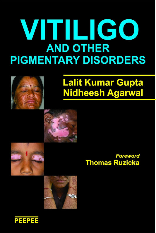 Vitiligo And Other Pigmentary Disorders-Lalit Gupta  Grab2Buy Peepee Publishers Grab2Buy