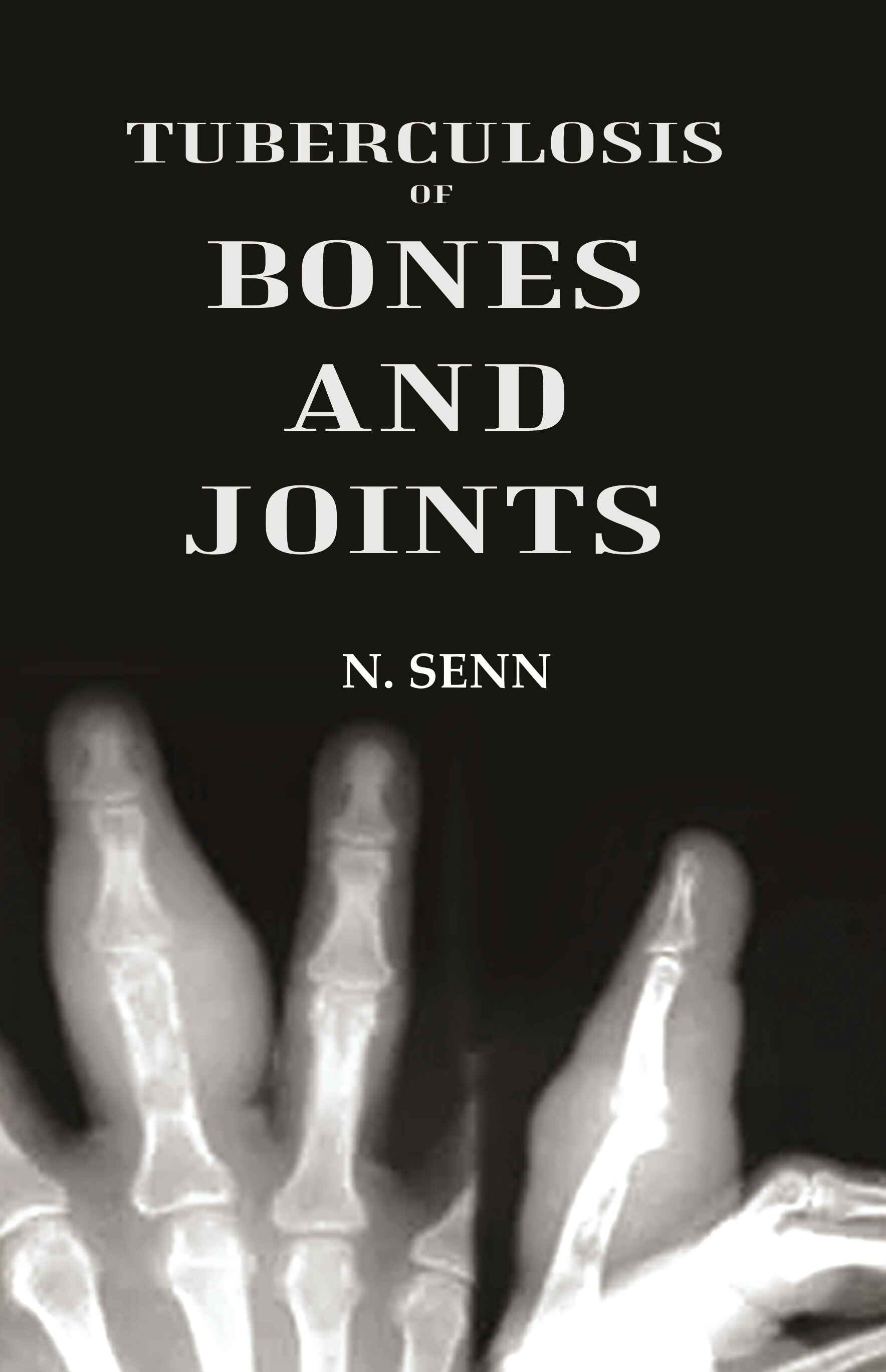 Tuberculosis of Bones and Joints - Gyan Books 