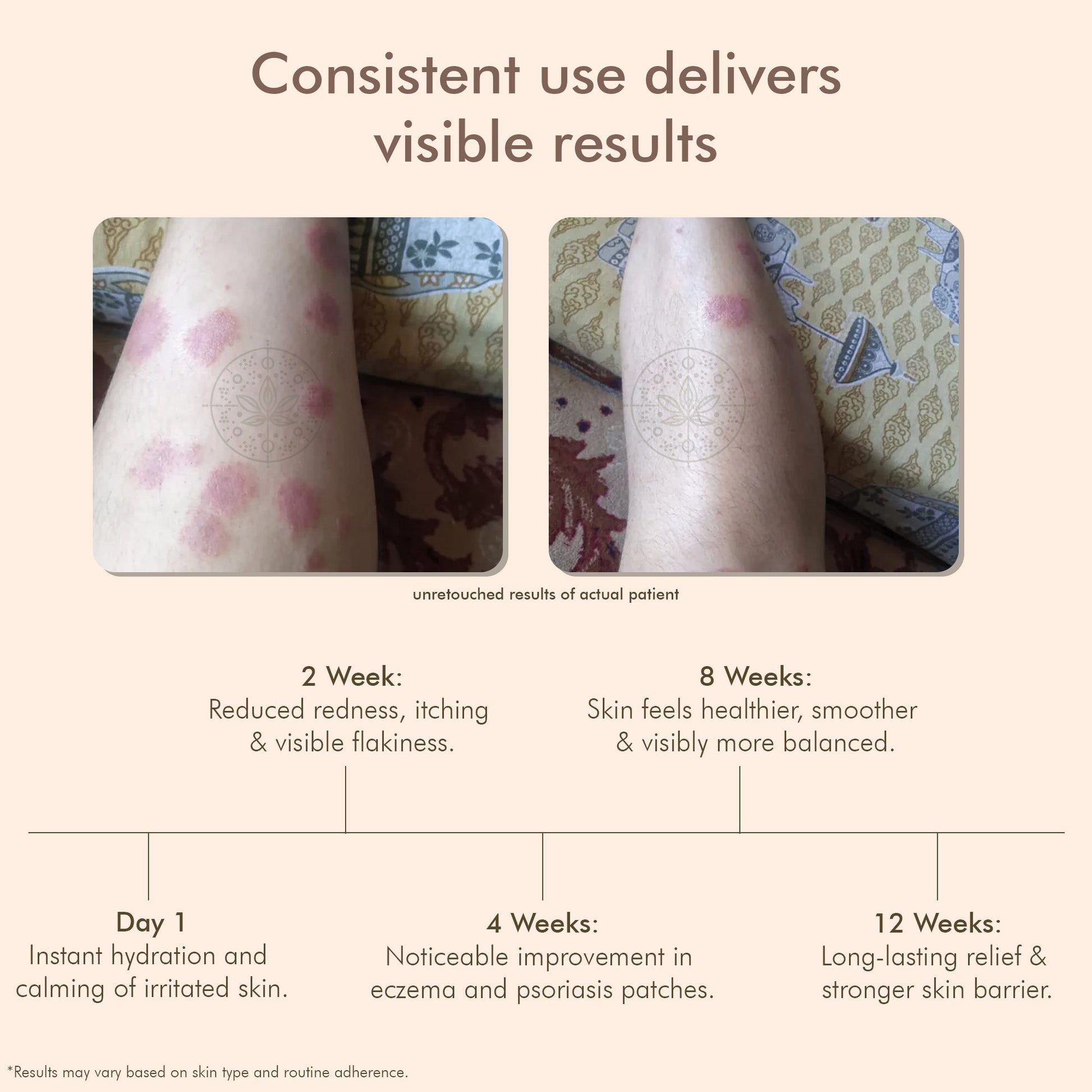 VedicDerm Oleander's Oil for Psoriasis, Eczema, and Atopic Dermatitis  Grab2Buy VedicDerm Grab2Buy