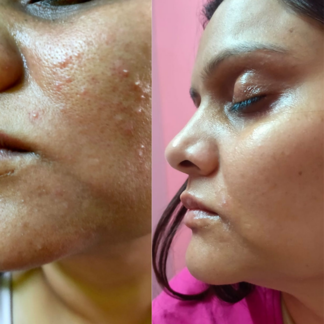 House of Beauty Acne Drying Serum 