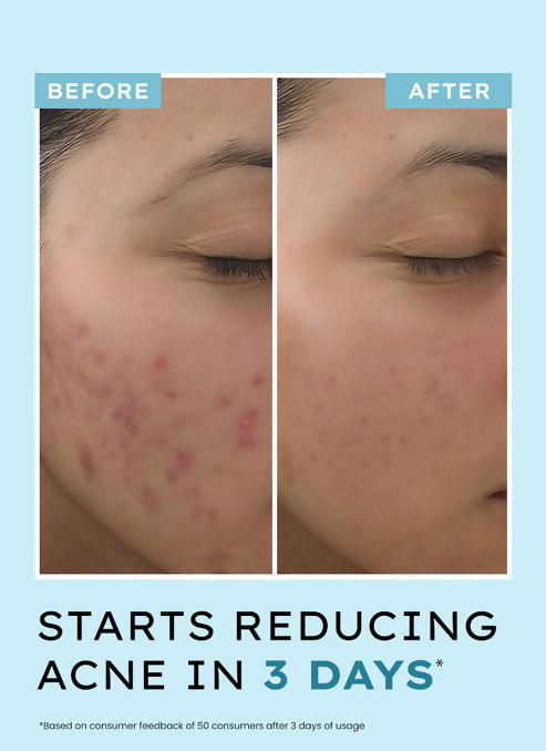 Hyphen By Kriti Sanon Acne Defence Daily Serum With 2% Salicylic Acid Treats Active Acne Prevents Breakouts 