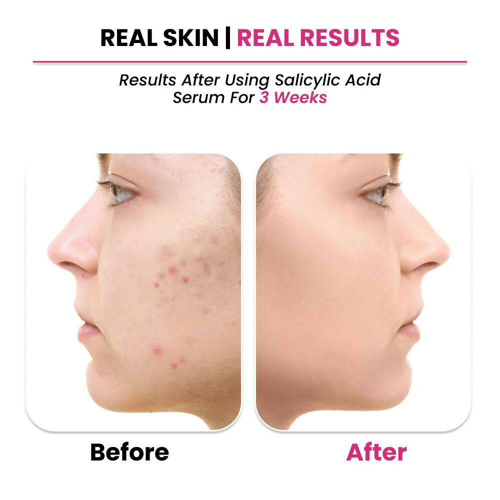 ThriveCo 2% Salicylic acid Serum 