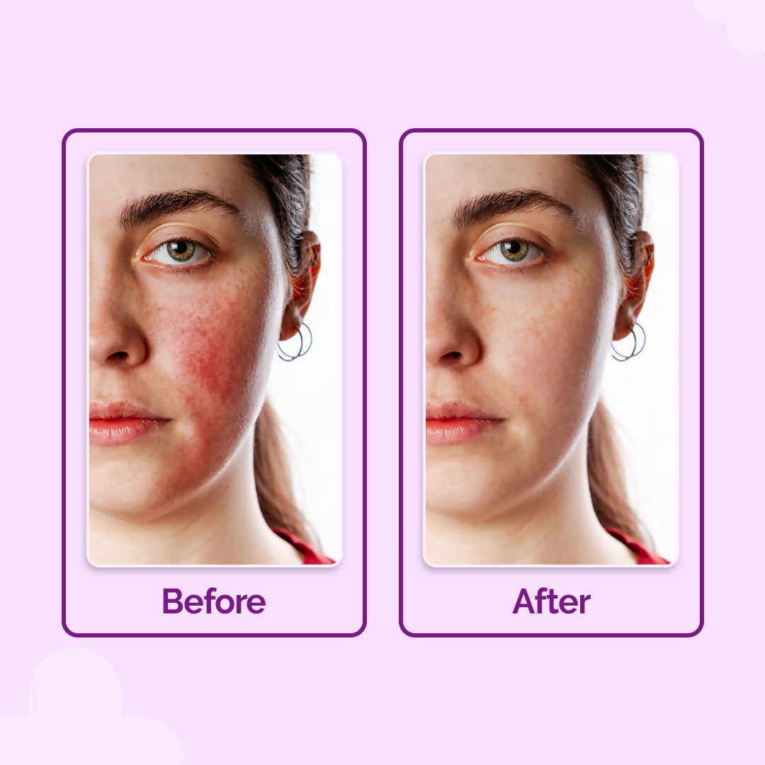 The Derma Co Hypochlorous Anti-Acne Hydrating Spray  Grab2Buy The Derma Co Grab2Buy