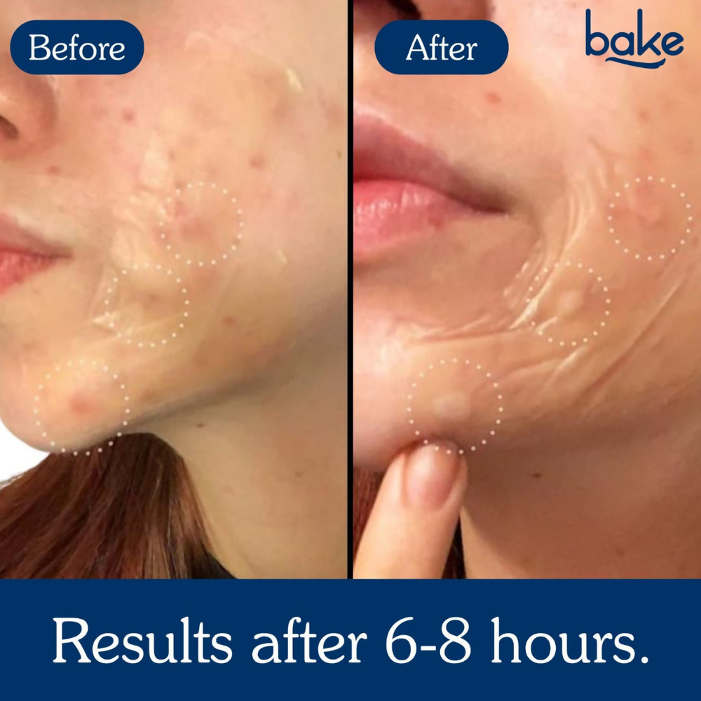 Bake Acne Erase XL Pimple Patches & Nose Patches  Grab2Buy Bake Grab2Buy