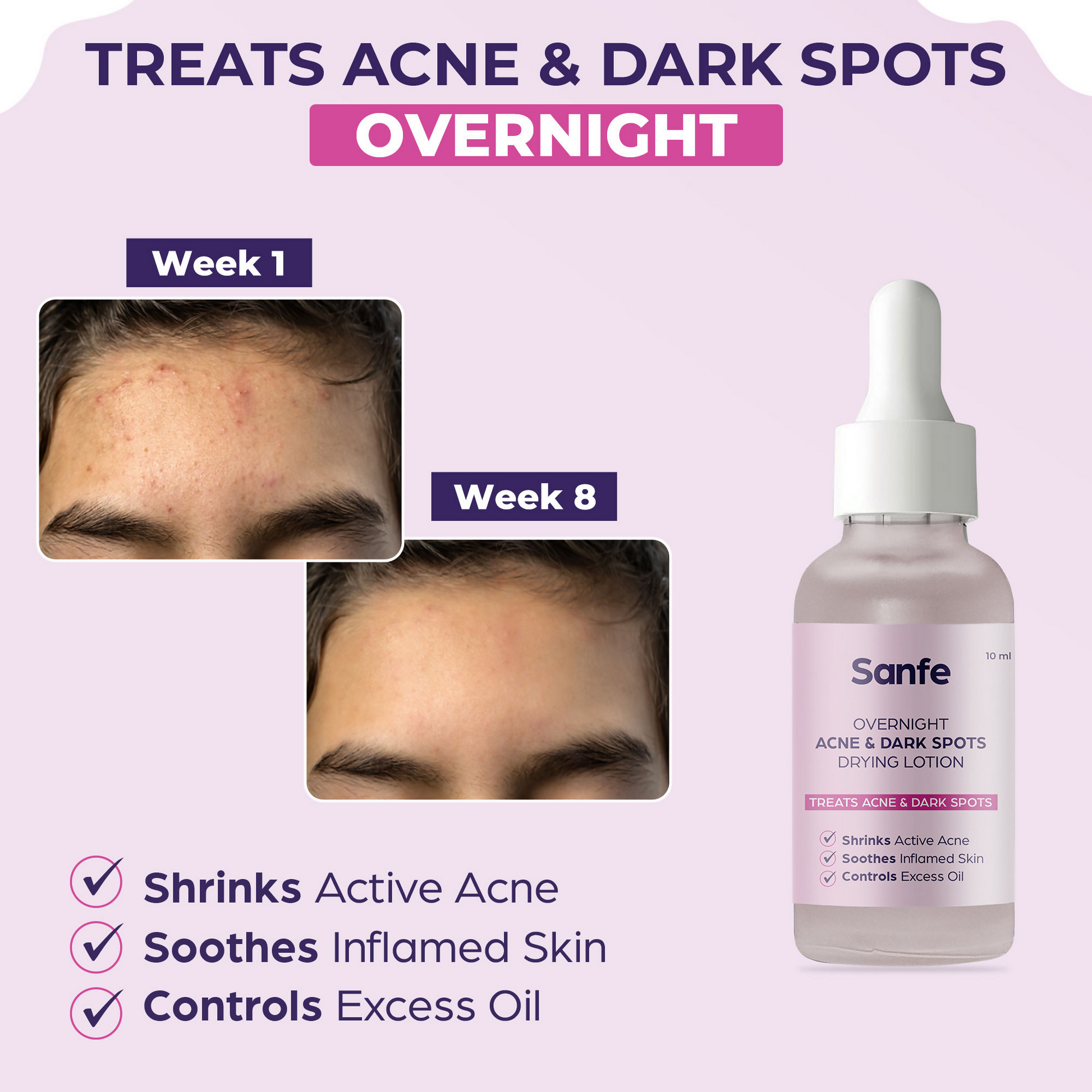 Sanfe Overnight Acne & Dark Spots Drying Lotion 
