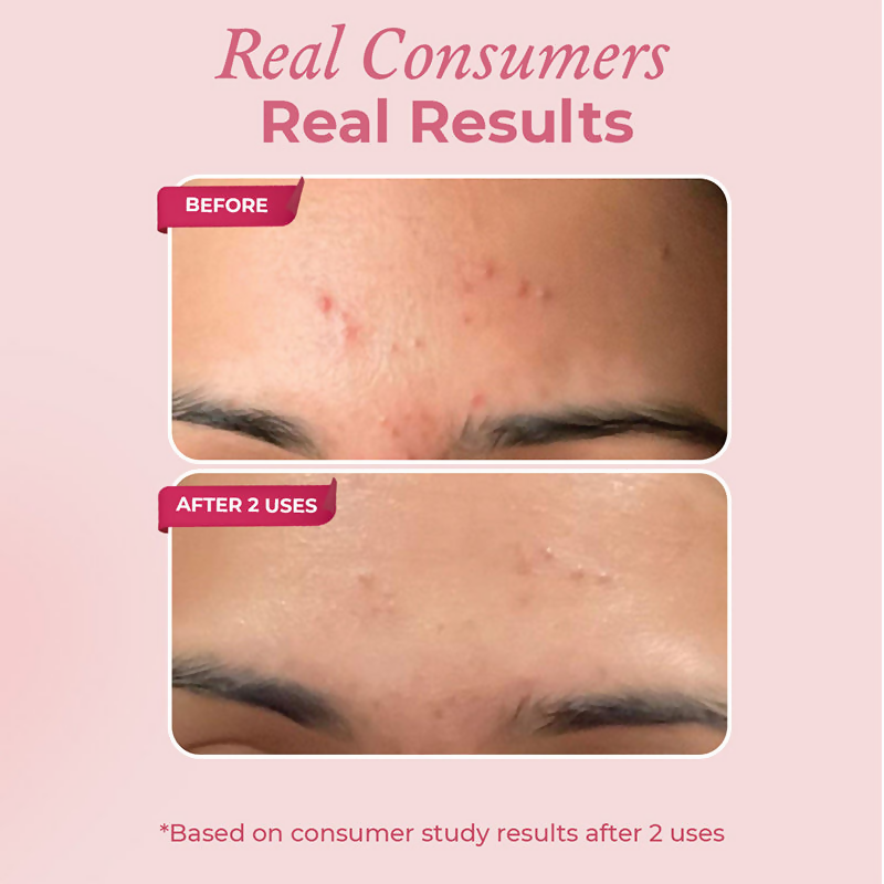 The Pink Foundry Acne Spot Corrector With Salicylic Acid For Active Acne Blackheads & Whiteheads  Grab2Buy The Pink Foundry Grab2Buy