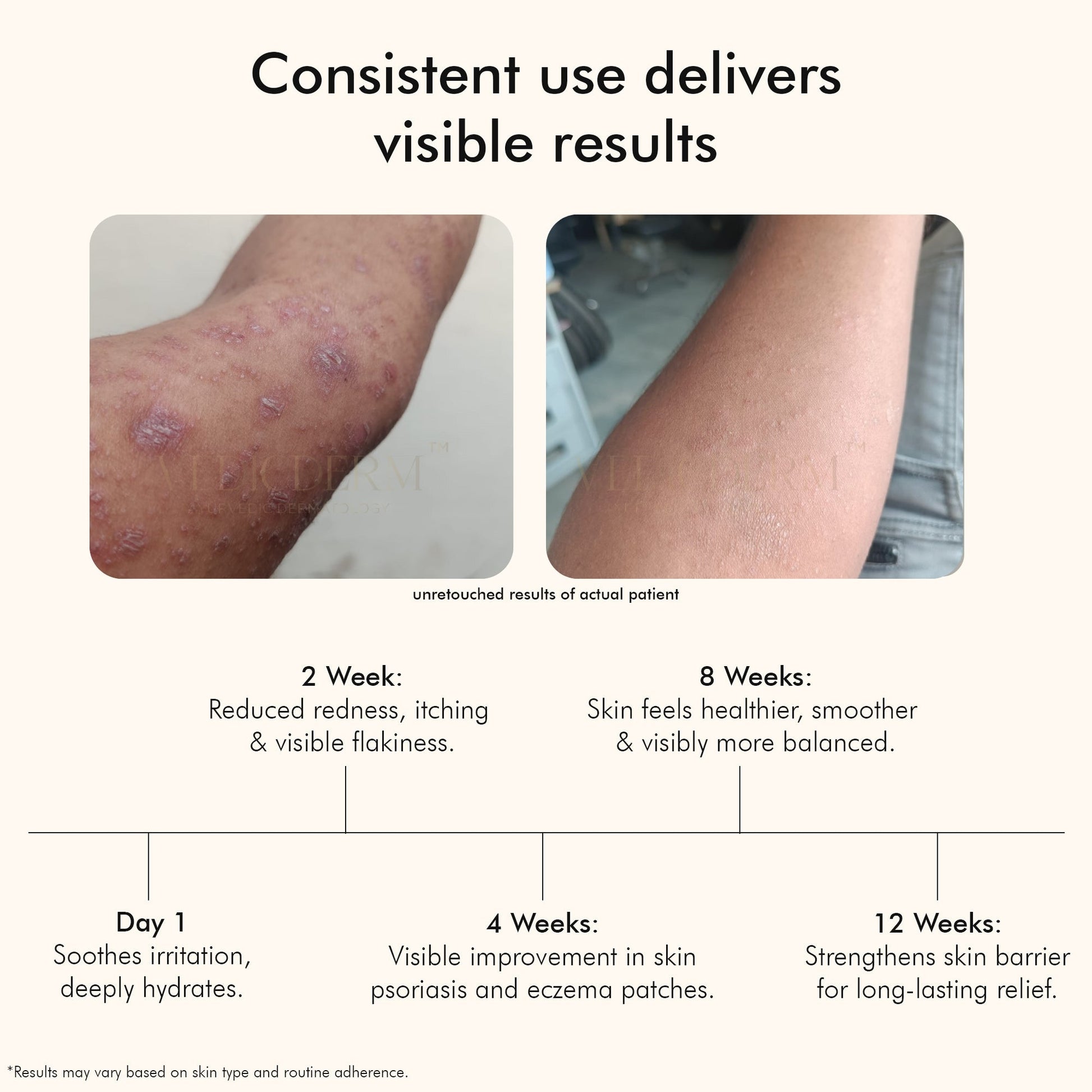 Vedicderm Psoriasis Cream with 2% Bakuchi Extract  Grab2Buy VedicDerm Grab2Buy