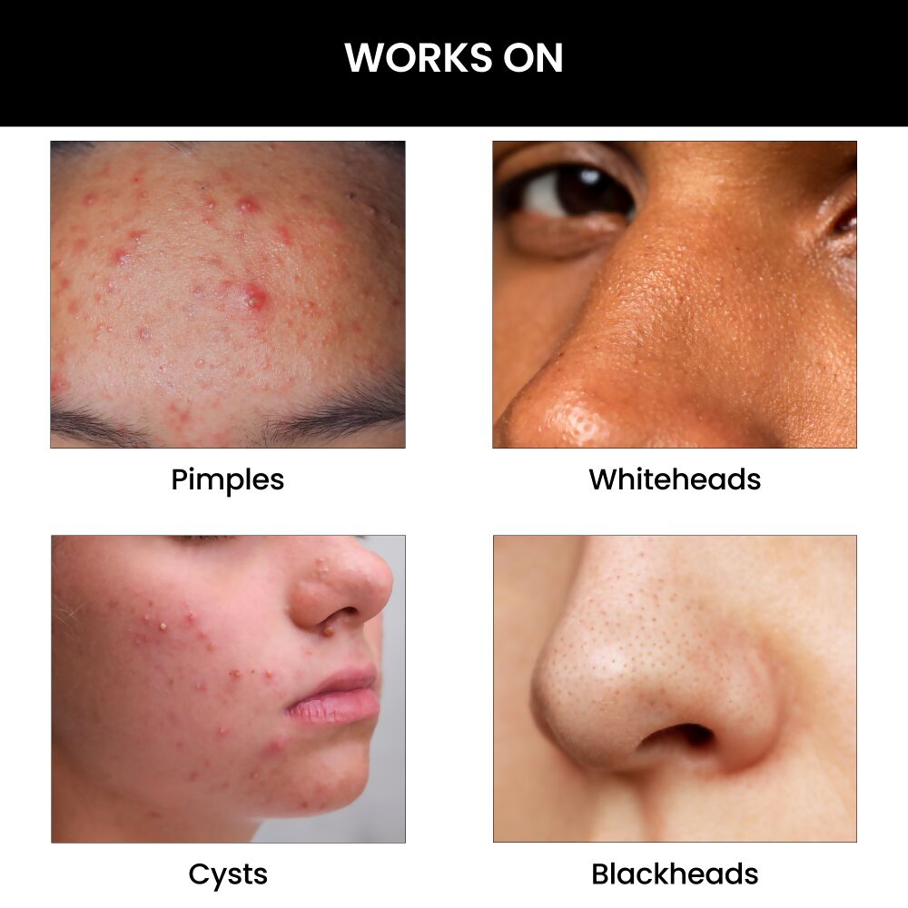 ThriveCo Goodbye Acne Kit 
