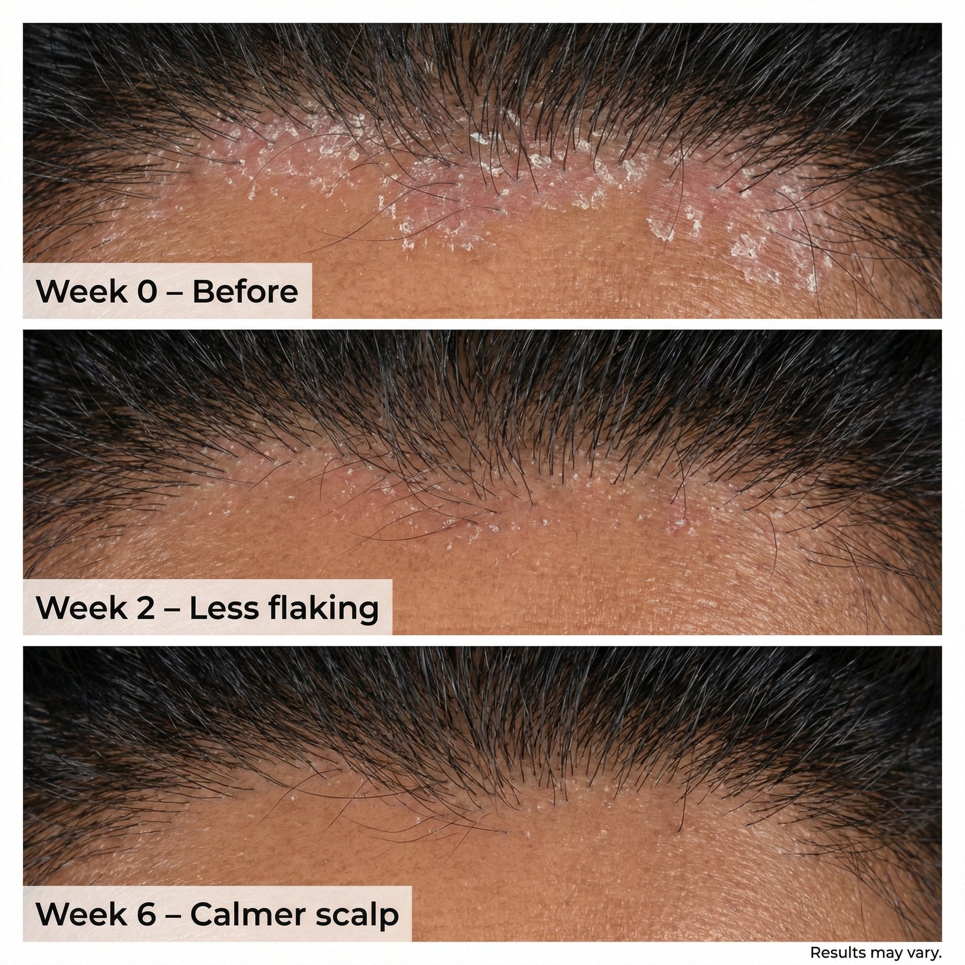 VedicDerm Plasma Bamboo Charcoal Shampoo for Psoriasis & Sensitive Scalp  Grab2Buy VedicDerm Grab2Buy