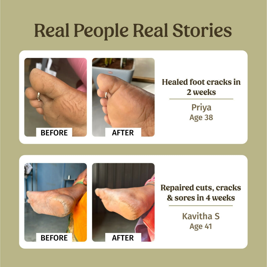 Vilvah Store Foot Cream (Treats Cracked Heels)  Grab2Buy Vilvah Store Grab2Buy