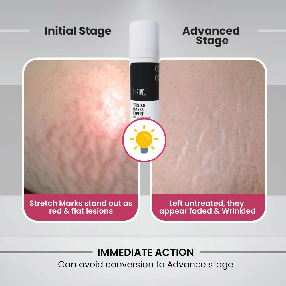 ThriveCo Stretch Marks Expert Serum Cream 