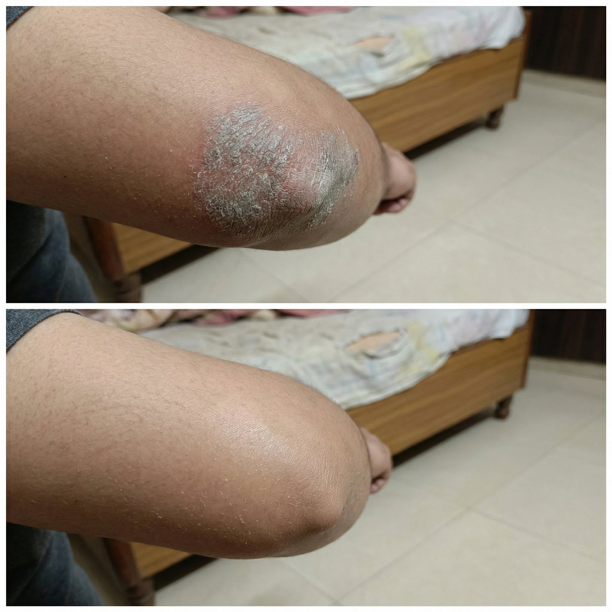 Vedicderm Psoriasis Cream  Grab2Buy VedicDerm Grab2Buy