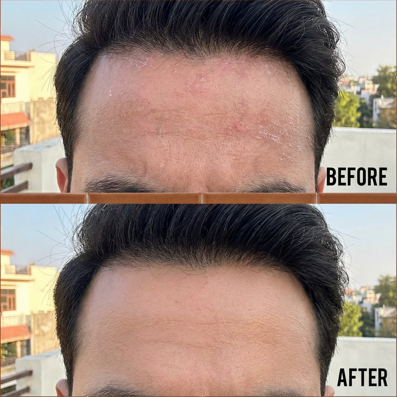 Vedicderm Psoriasis Oil 2-in-1 Skin + Scalp Relief Oil  Grab2Buy VedicDerm Grab2Buy