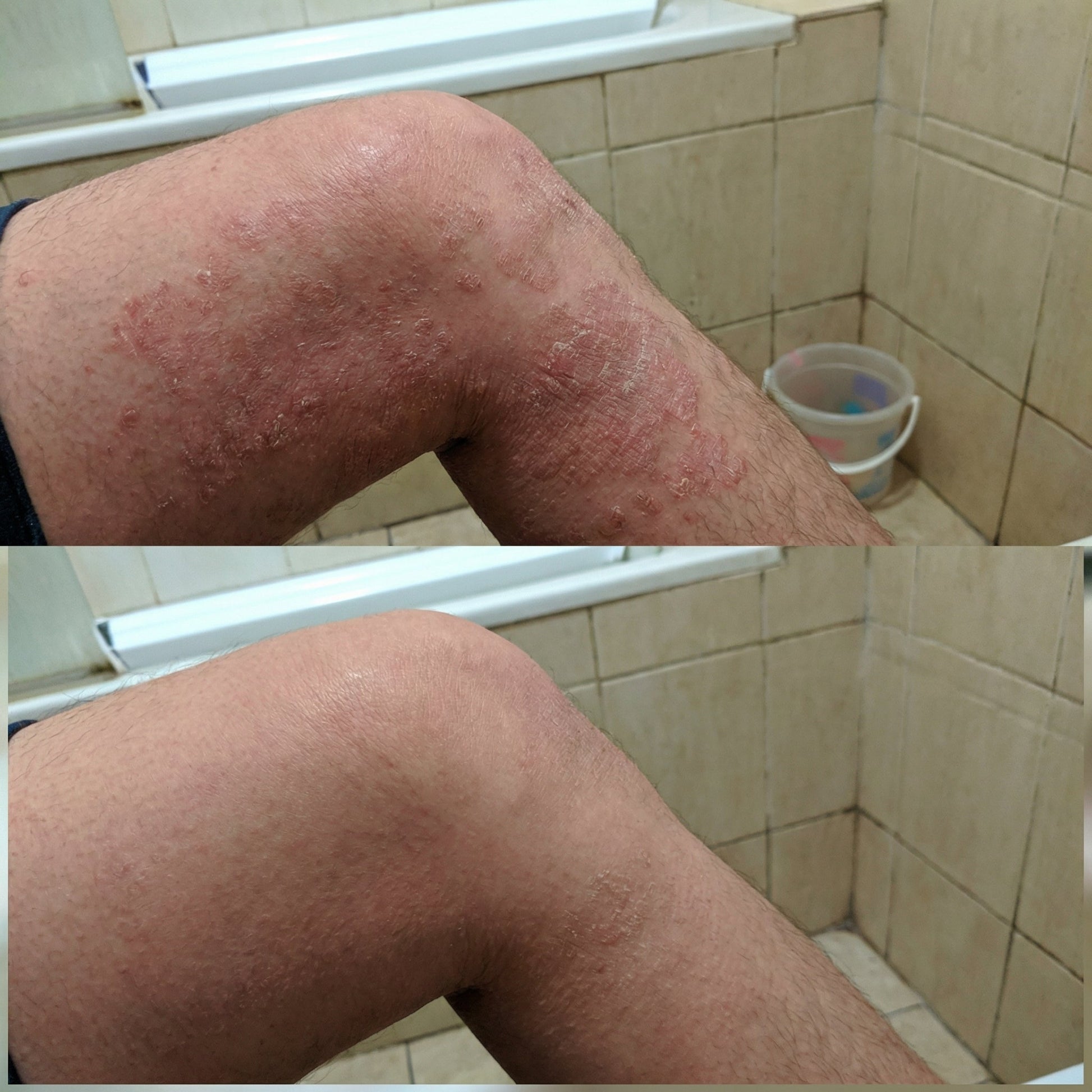 Vedicderm Psoriasis Cream  Grab2Buy VedicDerm Grab2Buy