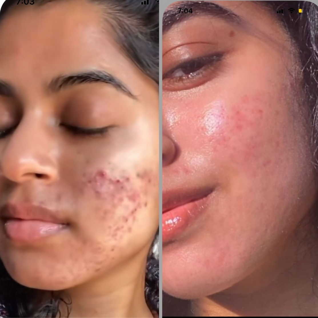House of Beauty Acne Drying Serum 